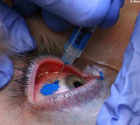 eyeball tattooing. i hear eyeball tattoos are