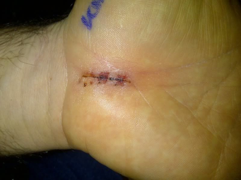 Incision.jpg